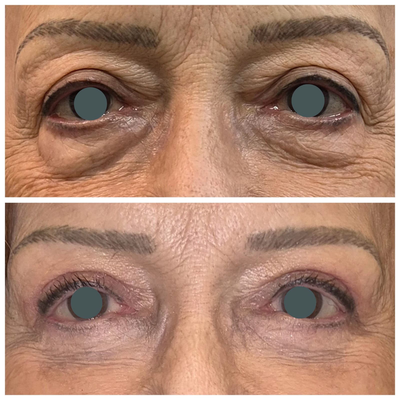 Antes e depois de blefaroplastia 2